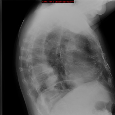Hydatidose thoracique, hépatique et splénique avec nodules pulmonaires excavés  Radiographie Thorax