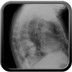 Hydatidose thoracique, hépatique et splénique avec nodules pulmonaires excavés  Radiographie Thorax