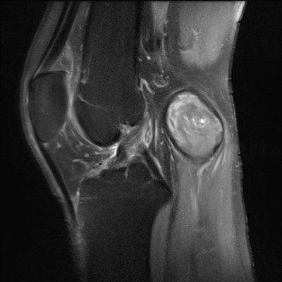 Anévrysme poplité thrombosé DP FS Sagittal