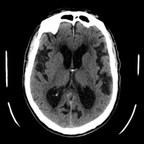 Hydrocéphalie à pression normale (Hydrocéphalie chronique de l'adulte) Axial Hydrocéphalie à pression normale (Hydrocéphalie chronique de l'adulte) Axial