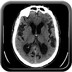 Hydrocéphalie à pression normale (Hydrocéphalie chronique de l'adulte) Axial
