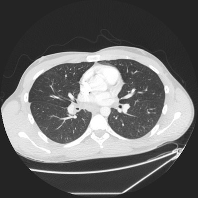 Pneumopathie infectieuse de la base droite Axial Parenchyme