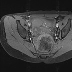 Endométriose sévère avec atteinte digestive. IRM Pelvis Axial T1 fat sat Endométriose sévère avec atteinte digestive. IRM Pelvis Axial T1 fat sat