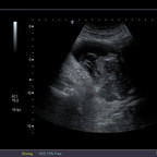 Néoplasie prostatique multimétastatique Echographie vésicale Néoplasie prostatique multimétastatique Echographie vésicale