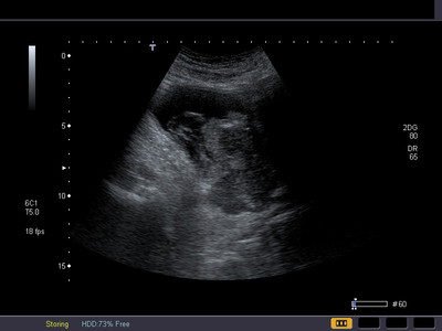 Néoplasie prostatique multimétastatique Echographie vésicale