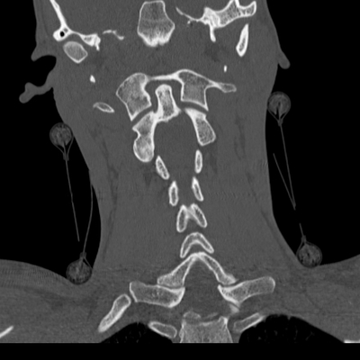rupture de la veine rénale, hématome de la surrénale rachis cervical coro os