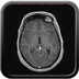 HEMANGIOBLASTOME  IRM Crâne Axial Gadolinium