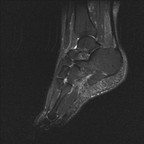 Syndrome du canal tarsien secondaire à un kyste arthro-synovial de l'articulation sous talienne. Fissuration partielle à l'enthèse du tendon calcanéen. T2 STIR Sagittal Syndrome du canal tarsien secondaire à un kyste arthro-synovial de l'articulation sous talienne. Fissuration partielle à l'enthèse du tendon calcanéen. T2 STIR Sagittal
