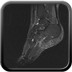 Syndrome du canal tarsien secondaire à un kyste arthro-synovial de l'articulation sous talienne. Fissuration partielle à l'enthèse du tendon calcanéen. T2 STIR Sagittal