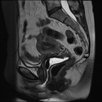 Cancer du col utérin étendu sur 20 mm de hauteur et de grand axe transversal avec doute sur une atteinte du paramètre gauche (interruption d'un anneau fibreux péri-cervical) : probable stade II b Sagittal T2 Cancer du col utérin étendu sur 20 mm de hauteur et de grand axe transversal avec doute sur une atteinte du paramètre gauche (interruption d'un anneau fibreux péri-cervical) : probable stade II b Sagittal T2