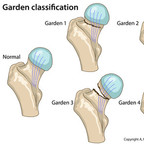 Femoral neck fractures Garden-Classification-Femoral-neck-fractures Femoral neck fractures Garden-Classification-Femoral-neck-fractures
