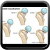 Femoral neck fractures Garden-Classification-Femoral-neck-fractures