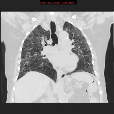 Pneumopathie interstitielle fibrosante à la cordarone  TDM Thorax Coronal