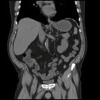 Calcul coralliforme du rein droit TDM Abdomen Coronal Sans injection Calcul coralliforme du rein droit TDM Abdomen Coronal Sans injection