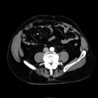 Mélanome du grele. TDM Abdomen Axial Temps veineux Mélanome du grele. TDM Abdomen Axial Temps veineux