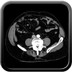 Mélanome du grele.  TDM Abdomen Axial Temps veineux