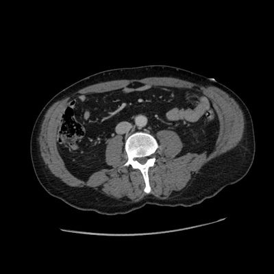 Subarachnoid Hemorrhage, Traumatic, Pneumothorax, Sternum fracture Abdomen CT, Axial plane, Portal venous phase