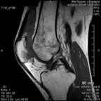 Rupture du retinaculum médial SAG T1 Rupture du retinaculum médial SAG T1