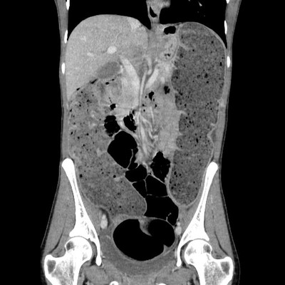 Rectal obstruction due to endometriosis Coronal CT