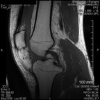 Rupture totale du ligament croisé antérieur associé à une luxation de la corne postérieure du ménisque latéral SAGITTAL T1 Rupture totale du ligament croisé antérieur associé à une luxation de la corne postérieure du ménisque latéral SAGITTAL T1