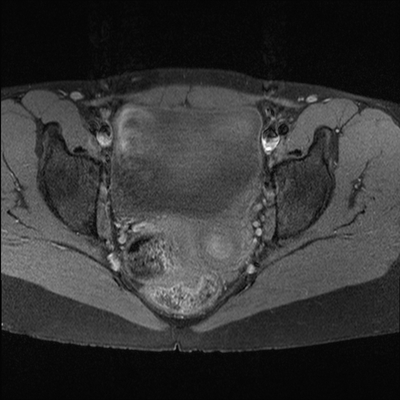 Volumineux fibrome sous-séreux pédiculé avec remaniements oedémateux Axial T1 Fat Sat