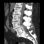 Canal lombaire rétréci Sagittal (mou) Canal lombaire rétréci Sagittal (mou)