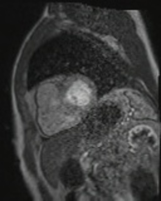 Dysplasie arythmogène du ventriule droit (DAVD) : critère majeur en IRM PERFUSION RespLib _dynamic_rest_MOCO