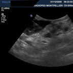 Panniculite mésentérique US abdominale Panniculite mésentérique US abdominale