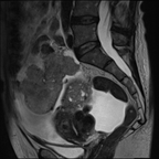 Cystadénocarcinome ovarien séro-papillaire moyennement différencié Stade IIIb Sagittal T2 Cystadénocarcinome ovarien séro-papillaire moyennement différencié Stade IIIb Sagittal T2