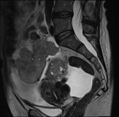 Cystadénocarcinome ovarien séro-papillaire moyennement différencié Stade IIIb Sagittal T2