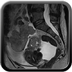 Cystadénocarcinome ovarien séro-papillaire moyennement différencié Stade IIIb Sagittal T2
