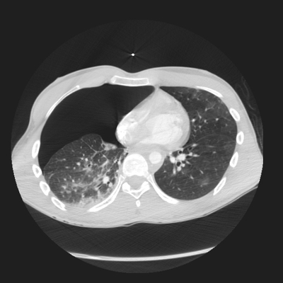 Thoracic Injuries, Subcapsular hemorrhage of liver, Pelvic injury Chest, Lung window