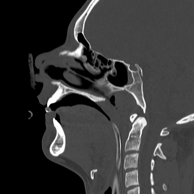 traumatisme cranien, fracture du massif facial, traumatisme thoracique, fracture pelvienne, traumatisme spléno-rénal face sag os