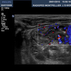 Hyperplasie lymphoïde de la dernière anse iléale. Echo région iléo-caecale Hyperplasie lymphoïde de la dernière anse iléale. Echo région iléo-caecale