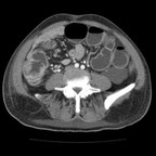Cancer colique fistulé au deuxième duodénum avec envahissement pancréatique. TDM Abdomen Axial Temps veineux Cancer colique fistulé au deuxième duodénum avec envahissement pancréatique. TDM Abdomen Axial Temps veineux