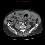 Carcinose péritonéale étendue sur néoplasie colique. TDM Abdomen Pelvis Axial Produit : Iode Temps veineux Carcinose péritonéale étendue sur néoplasie colique. TDM Abdomen Pelvis Axial Produit : Iode Temps veineux