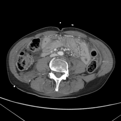 Craniocerebral trauma, Carotid artery injury with dissection, traumatic perforation of GI tract, pulmonary artery injury, Chance fracture Abdomen CT,  Portal venous phase, Axial plane
