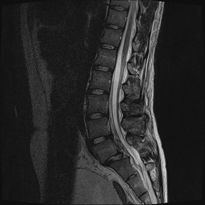 Thoracic Injuries, Spinal Injuries L5, Traumatic disc herniation Lumbar MRI, T2, Sagittal plane