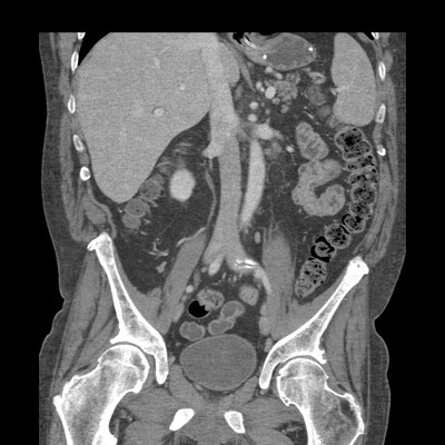 Epaississement jéjunal isolé en rapport avec une maladie de Crohn.  TDM Abdomen Coronal Temps veineux