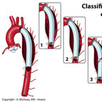 Endoprothèses aortiques Classification des endofuites aortiques Endoprothèses aortiques Classification des endofuites aortiques