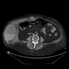 Volumineux hématome pariétal abdominal avec multiples saignements actifs veineux Sans injection Volumineux hématome pariétal abdominal avec multiples saignements actifs veineux Sans injection