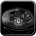 Volumineux hématome pariétal abdominal avec multiples saignements actifs veineux Sans injection