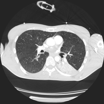 Severe cranioencephalic injuries, Carotid artery dissection, Aspiration pneumonia, Pelvic fracture Chest CT, Lung window, Axial plane