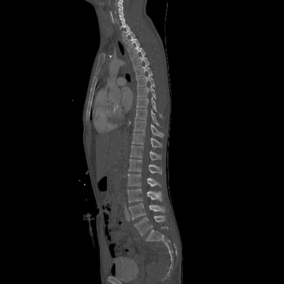 traumatisme cranien, fracture du massif facial, traumatisme thoracique, fracture pelvienne, traumatisme spléno-rénal TAP sagittal os