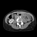 Ganglioneurome de la surrénale droite. TDM Abdomen Axial Temps artériel Ganglioneurome de la surrénale droite. TDM Abdomen Axial Temps artériel