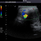 Anévrysme poplité thrombosé Echographie Anévrysme poplité thrombosé Echographie