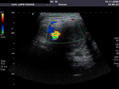Anévrysme poplité thrombosé Echographie