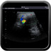 Anévrysme poplité thrombosé Echographie