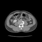 Pyélonéphrite bilatérale associée à une appendicite. TDM Abdomen Pelvis Axial Temps veineux Pyélonéphrite bilatérale associée à une appendicite. TDM Abdomen Pelvis Axial Temps veineux
