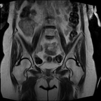 Cancer de l'endomètre du fond utérin, s'étendant jusqu'à l'isthme, sans envahissement de la zone jonctionnelle, classée FIGO 1a Coronal T2 Grand Champ Cancer de l'endomètre du fond utérin, s'étendant jusqu'à l'isthme, sans envahissement de la zone jonctionnelle, classée FIGO 1a Coronal T2 Grand Champ